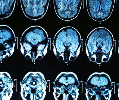 Seeking the origins of Alzheimers and Dementia